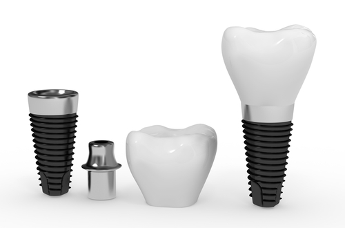 Teeth Crowns Vs. Implants