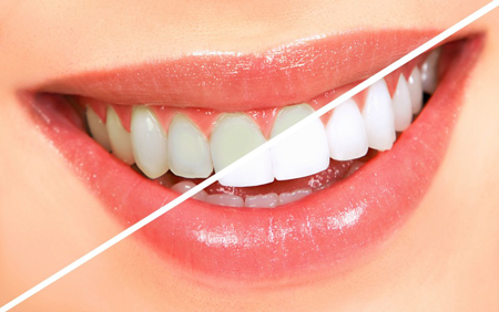 DIY Vs. Professional Teeth Whitening