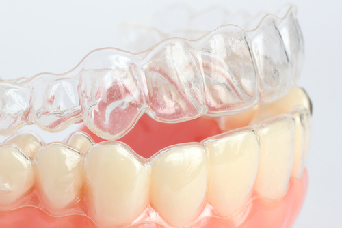 Invisalign vs. Traditional Brace – Which Option Is Better?